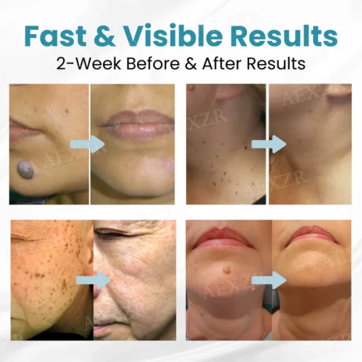 ZEFIU™ Non-Invasive Mole and Wart Removal Laser Pen - Image 2