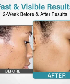Bikenda® SpotAway Painless Laser Mole Removal Pen