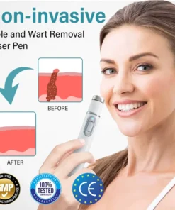 Bikenda® SpotAway Painless Laser Mole Removal Pen