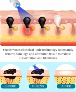 Slimoly™ LumeSkin Mole and Wart Removal Laser Pen