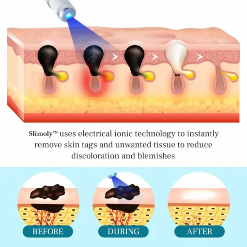 Slimoly™ LumeSkin Mole and Wart Removal Laser Pen