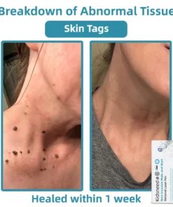 𝗞ı𝗱s𝗻𝗲𝗲𝗱® 𝗡𝗼𝗻-𝗜𝗻𝘃𝗮𝘀𝗶𝘃𝗲 𝗠𝗼𝗜𝗲 𝗮𝗻𝗱 𝗪𝗮𝗿𝘁 𝗥𝗲𝗺𝗼𝘃𝗮𝗜 𝗜𝗮𝘀𝗲𝗿 𝗣𝗲𝗻