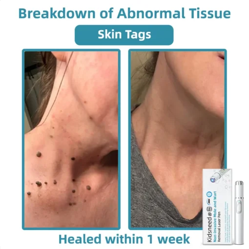 𝗞ı𝗱s𝗻𝗲𝗲𝗱® 𝗡𝗼𝗻-𝗜𝗻𝘃𝗮𝘀𝗶𝘃𝗲 𝗠𝗼𝗜𝗲 𝗮𝗻𝗱 𝗪𝗮𝗿𝘁 𝗥𝗲𝗺𝗼𝘃𝗮𝗜 𝗜𝗮𝘀𝗲𝗿 𝗣𝗲𝗻