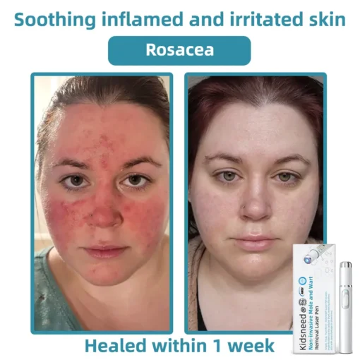 𝗞ı𝗱s𝗻𝗲𝗲𝗱® 𝗡𝗼𝗻-𝗜𝗻𝘃𝗮𝘀𝗶𝘃𝗲 𝗠𝗼𝗜𝗲 𝗮𝗻𝗱 𝗪𝗮𝗿𝘁 𝗥𝗲𝗺𝗼𝘃𝗮𝗜 𝗜𝗮𝘀𝗲𝗿 𝗣𝗲𝗻