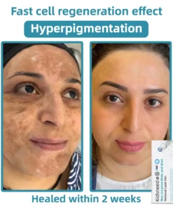 𝗞ı𝗱s𝗻𝗲𝗲𝗱® 𝗡𝗼𝗻-𝗜𝗻𝘃𝗮𝘀𝗶𝘃𝗲 𝗠𝗼𝗜𝗲 𝗮𝗻𝗱 𝗪𝗮𝗿𝘁 𝗥𝗲𝗺𝗼𝘃𝗮𝗜 𝗜𝗮𝘀𝗲𝗿 𝗣𝗲𝗻