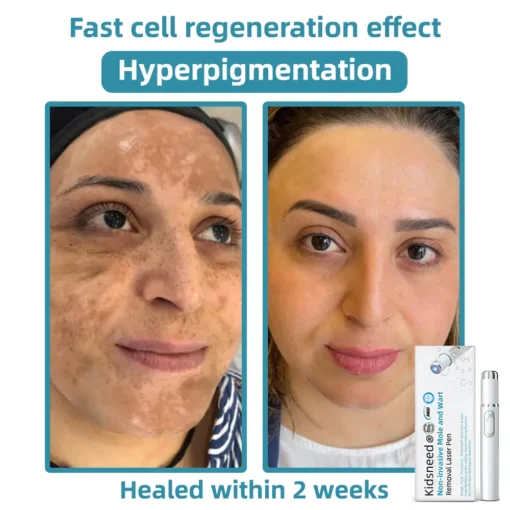 𝗞ı𝗱s𝗻𝗲𝗲𝗱® 𝗡𝗼𝗻-𝗜𝗻𝘃𝗮𝘀𝗶𝘃𝗲 𝗠𝗼𝗜𝗲 𝗮𝗻𝗱 𝗪𝗮𝗿𝘁 𝗥𝗲𝗺𝗼𝘃𝗮𝗜 𝗜𝗮𝘀𝗲𝗿 𝗣𝗲𝗻