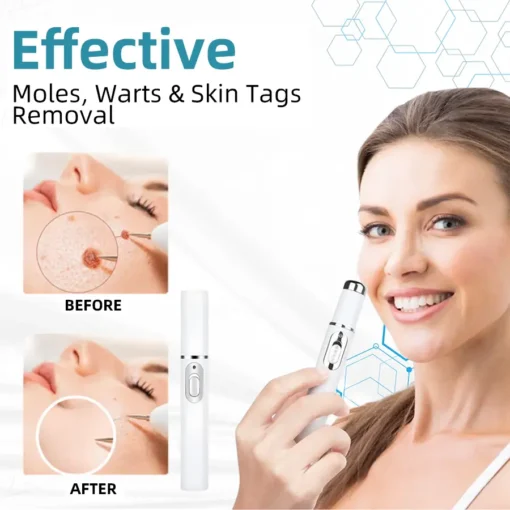 𝗞ı𝗱s𝗻𝗲𝗲𝗱® 𝗡𝗼𝗻-𝗜𝗻𝘃𝗮𝘀𝗶𝘃𝗲 𝗠𝗼𝗜𝗲 𝗮𝗻𝗱 𝗪𝗮𝗿𝘁 𝗥𝗲𝗺𝗼𝘃𝗮𝗜 𝗜𝗮𝘀𝗲𝗿 𝗣𝗲𝗻