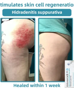 𝗞ı𝗱s𝗻𝗲𝗲𝗱® 𝗡𝗼𝗻-𝗜𝗻𝘃𝗮𝘀𝗶𝘃𝗲 𝗠𝗼𝗜𝗲 𝗮𝗻𝗱 𝗪𝗮𝗿𝘁 𝗥𝗲𝗺𝗼𝘃𝗮𝗜 𝗜𝗮𝘀𝗲𝗿 𝗣𝗲𝗻