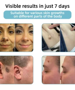 𝗞ı𝗱s𝗻𝗲𝗲𝗱® 𝗡𝗼𝗻-𝗜𝗻𝘃𝗮𝘀𝗶𝘃𝗲 𝗠𝗼𝗜𝗲 𝗮𝗻𝗱 𝗪𝗮𝗿𝘁 𝗥𝗲𝗺𝗼𝘃𝗮𝗜 𝗜𝗮𝘀𝗲𝗿 𝗣𝗲𝗻