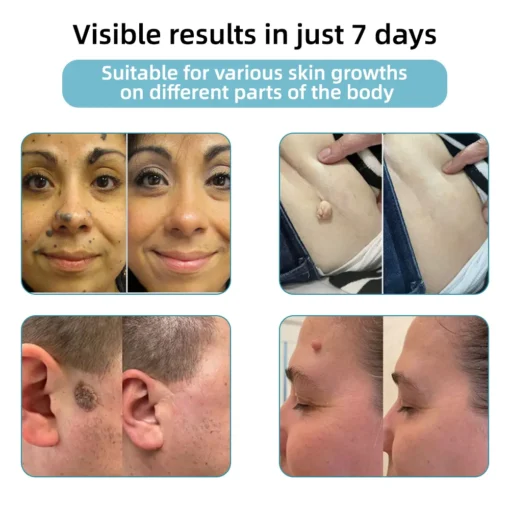 𝗞ı𝗱s𝗻𝗲𝗲𝗱® 𝗡𝗼𝗻-𝗜𝗻𝘃𝗮𝘀𝗶𝘃𝗲 𝗠𝗼𝗜𝗲 𝗮𝗻𝗱 𝗪𝗮𝗿𝘁 𝗥𝗲𝗺𝗼𝘃𝗮𝗜 𝗜𝗮𝘀𝗲𝗿 𝗣𝗲𝗻