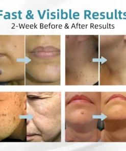 𝗞ı𝗱s𝗻𝗲𝗲𝗱® 𝗡𝗼𝗻-𝗜𝗻𝘃𝗮𝘀𝗶𝘃𝗲 𝗠𝗼𝗜𝗲 𝗮𝗻𝗱 𝗪𝗮𝗿𝘁 𝗥𝗲𝗺𝗼𝘃𝗮𝗜 𝗜𝗮𝘀𝗲𝗿 𝗣𝗲𝗻