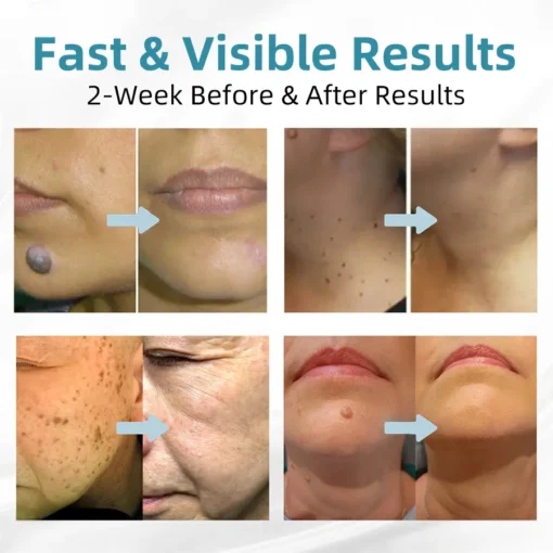 𝗞ı𝗱s𝗻𝗲𝗲𝗱® 𝗡𝗼𝗻-𝗜𝗻𝘃𝗮𝘀𝗶𝘃𝗲 𝗠𝗼𝗜𝗲 𝗮𝗻𝗱 𝗪𝗮𝗿𝘁 𝗥𝗲𝗺𝗼𝘃𝗮𝗜 𝗜𝗮𝘀𝗲𝗿 𝗣𝗲𝗻