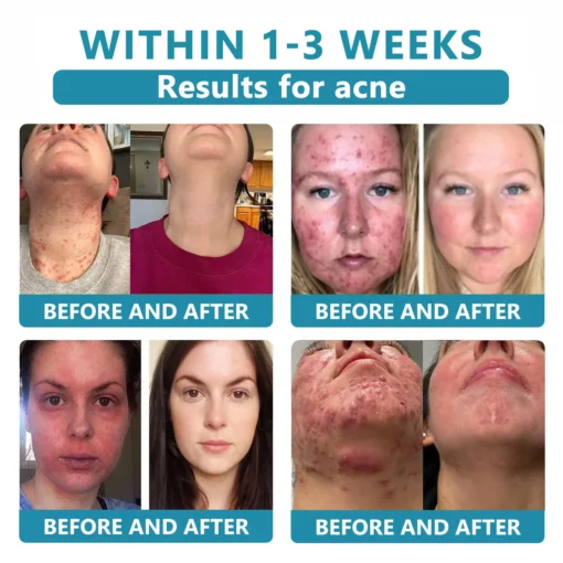 𝗞ı𝗱s𝗻𝗲𝗲𝗱® 𝗡𝗼𝗻-𝗜𝗻𝘃𝗮𝘀𝗶𝘃𝗲 𝗠𝗼𝗜𝗲 𝗮𝗻𝗱 𝗪𝗮𝗿𝘁 𝗥𝗲𝗺𝗼𝘃𝗮𝗜 𝗜𝗮𝘀𝗲𝗿 𝗣𝗲𝗻