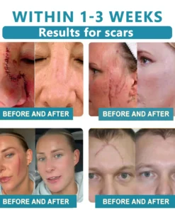 𝗞ı𝗱s𝗻𝗲𝗲𝗱® 𝗡𝗼𝗻-𝗜𝗻𝘃𝗮𝘀𝗶𝘃𝗲 𝗠𝗼𝗜𝗲 𝗮𝗻𝗱 𝗪𝗮𝗿𝘁 𝗥𝗲𝗺𝗼𝘃𝗮𝗜 𝗜𝗮𝘀𝗲𝗿 𝗣𝗲𝗻