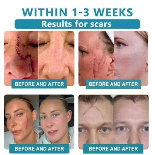 𝗞ı𝗱s𝗻𝗲𝗲𝗱® 𝗡𝗼𝗻-𝗜𝗻𝘃𝗮𝘀𝗶𝘃𝗲 𝗠𝗼𝗜𝗲 𝗮𝗻𝗱 𝗪𝗮𝗿𝘁 𝗥𝗲𝗺𝗼𝘃𝗮𝗜 𝗜𝗮𝘀𝗲𝗿 𝗣𝗲𝗻