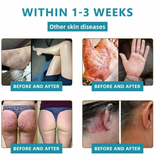 𝗞ı𝗱s𝗻𝗲𝗲𝗱® 𝗡𝗼𝗻-𝗜𝗻𝘃𝗮𝘀𝗶𝘃𝗲 𝗠𝗼𝗜𝗲 𝗮𝗻𝗱 𝗪𝗮𝗿𝘁 𝗥𝗲𝗺𝗼𝘃𝗮𝗜 𝗜𝗮𝘀𝗲𝗿 𝗣𝗲𝗻