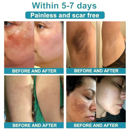 𝗞ı𝗱s𝗻𝗲𝗲𝗱® 𝗡𝗼𝗻-𝗜𝗻𝘃𝗮𝘀𝗶𝘃𝗲 𝗠𝗼𝗜𝗲 𝗮𝗻𝗱 𝗪𝗮𝗿𝘁 𝗥𝗲𝗺𝗼𝘃𝗮𝗜 𝗜𝗮𝘀𝗲𝗿 𝗣𝗲𝗻